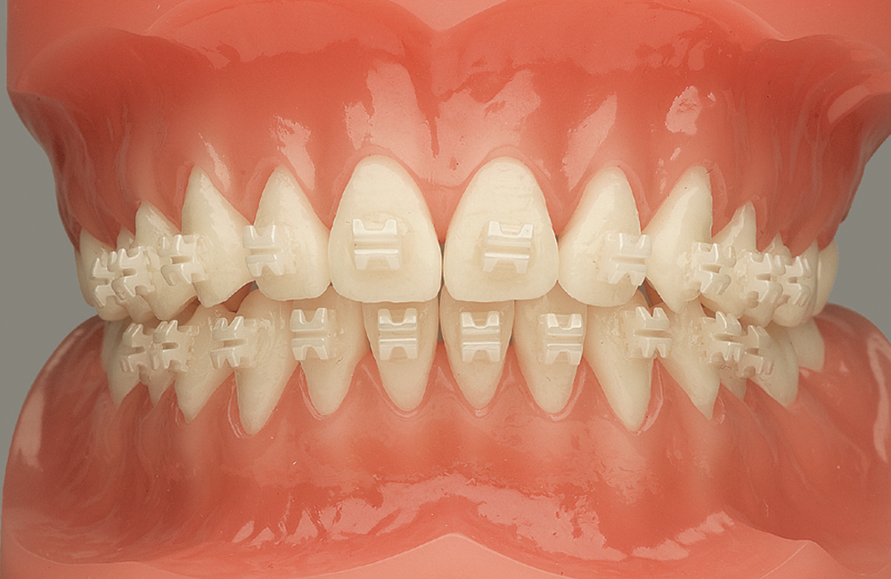 クリアブラケットによる表側矯正