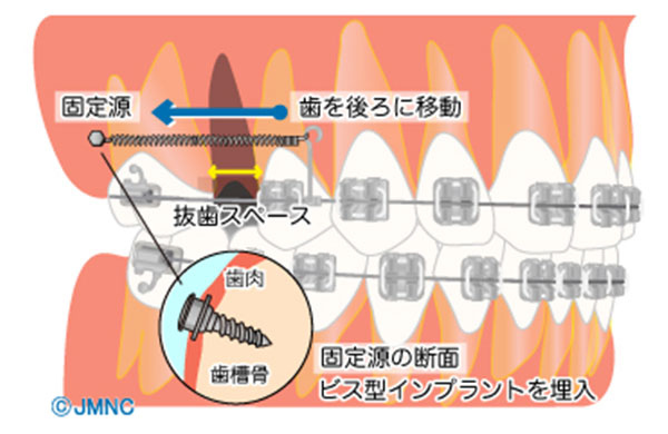 インプラント矯正